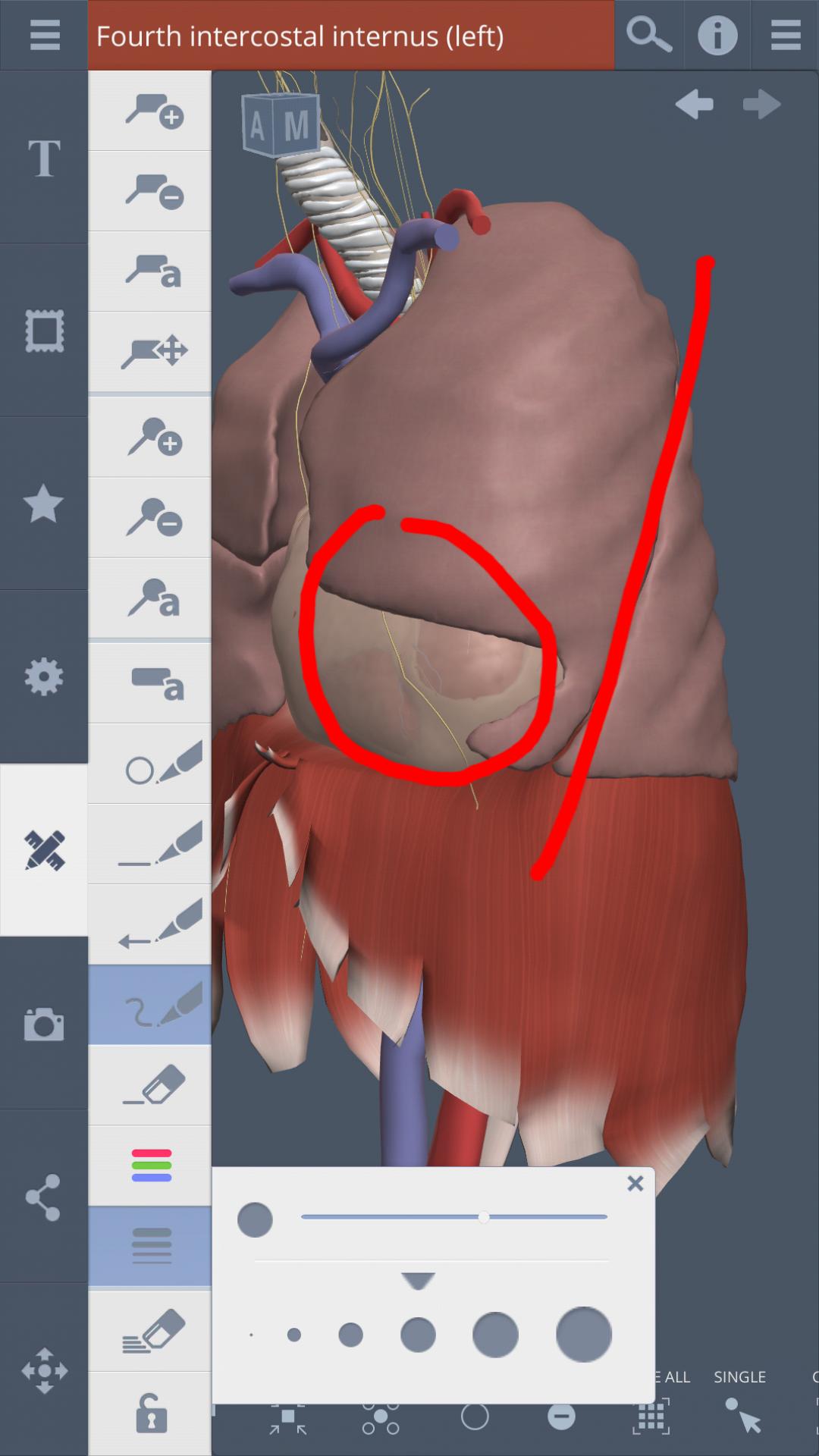 Thorax: 3D RT - Sub